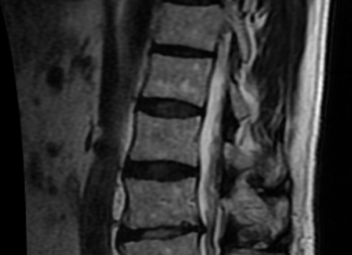 Lab-grown human spinal cord tissue shows signs of repair after injury, study finds